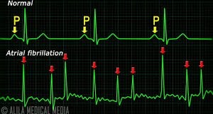 What is Atrial Fibrillation?