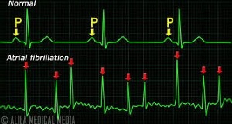 What is Atrial Fibrillation